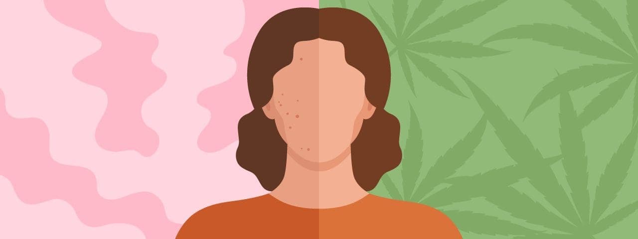 cbd for acne